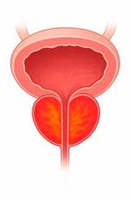 Inflamación da próstata